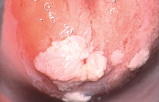 HPV, Κονδυλώματα