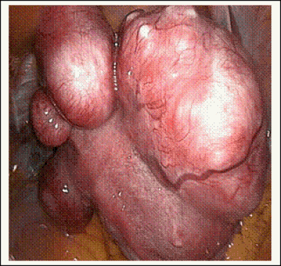 Ινομυώματα/ Πολύποδες Ινομυώματα/ Πολύποδες