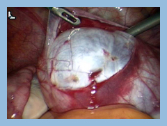 λαπαροσκόπηση