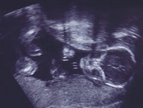 Πλάνο παρακολούθησης εγκύου