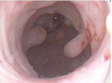 Υστεροσκοπική εικόνα ενδομητρικού πολύποδα υστεροσκόπηση