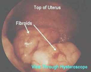Υστεροσκοπική εικόνα υποβλεννογόνιων ινομυωμάτων υστεροσκόπηση