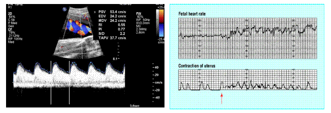 Υπερηχογράφημα Doppler Πλάνο παρακολούθησης εγκύου